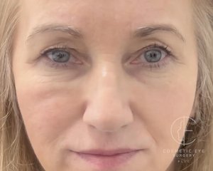 Upper Eyelid Blepharoplasty Patient Image #1