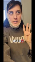 Vanessa, early combined neck lift and chin implant recovery