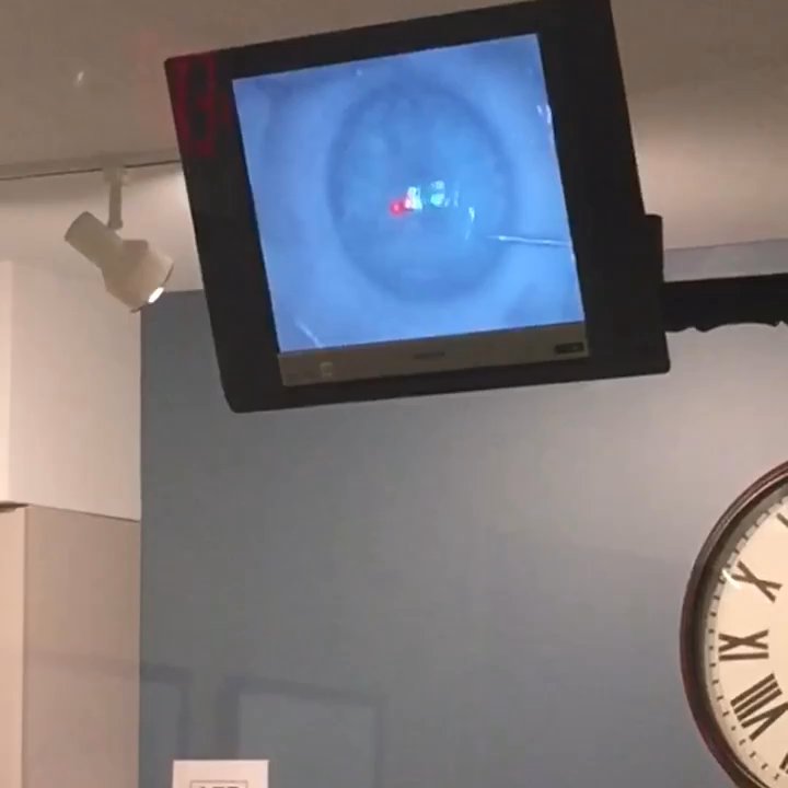 LasikPlus - Part two of two this machine is the laser. You can't feel anything on this at all it's just scary because you can't see then bright light. - Optometrists Near Me - Columbus, Ohio