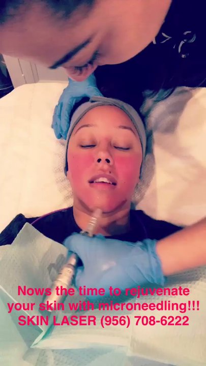 Skin Laser - Microneedling - Skin Care Near Me - McAllen, Texas