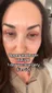 @nataliejillfit, day 1 after upper and lower blepharoplasty with fat transfer and a mild CO2 laser