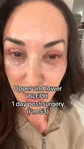 @nataliejillfit, day 1 after upper and lower blepharoplasty with fat transfer and a mild CO2 laser