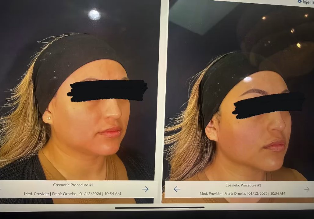 Collagene Aesthetics - My first XERF treatment with Dr. Ornelas and nurse Nadya. It was completely painless and the results were immediately seen. - Medical Spas Near Me - Glendora, California