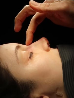 Rhinoplasty result at Eos Rejuvenation