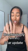 @karensandiego_, two weeks after arm lift
