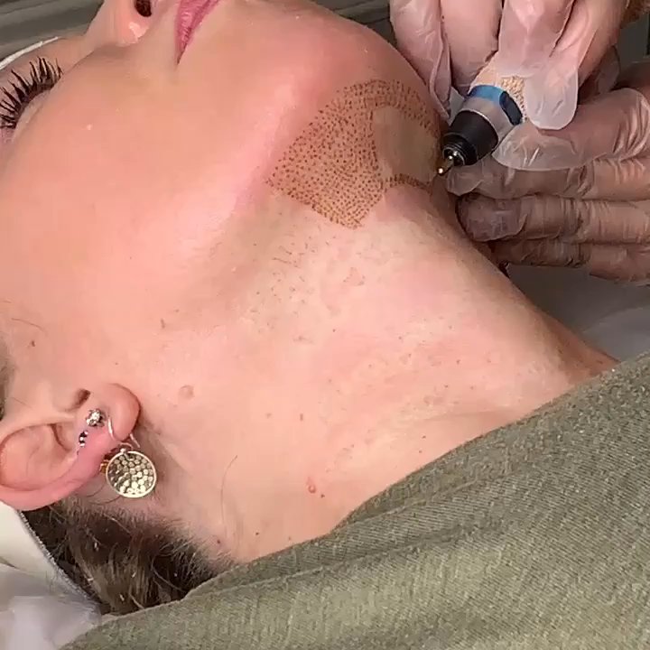 Heather Gordon Spa & Wellness - Plasma Pen in action - Skin Care Near Me - Austin, Texas