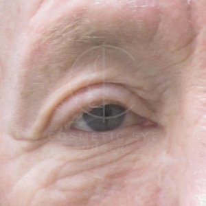 Ptosis Repair Surgery Patient Image #1
