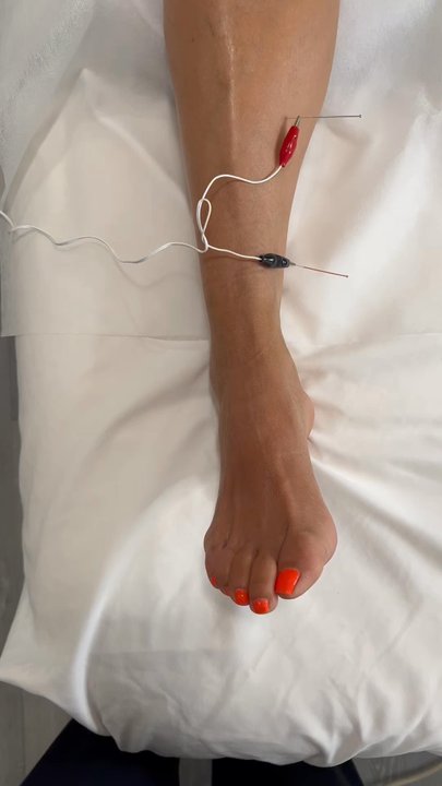 ACUREVERSE - Acupuncture Near Me - Costa Mesa, California