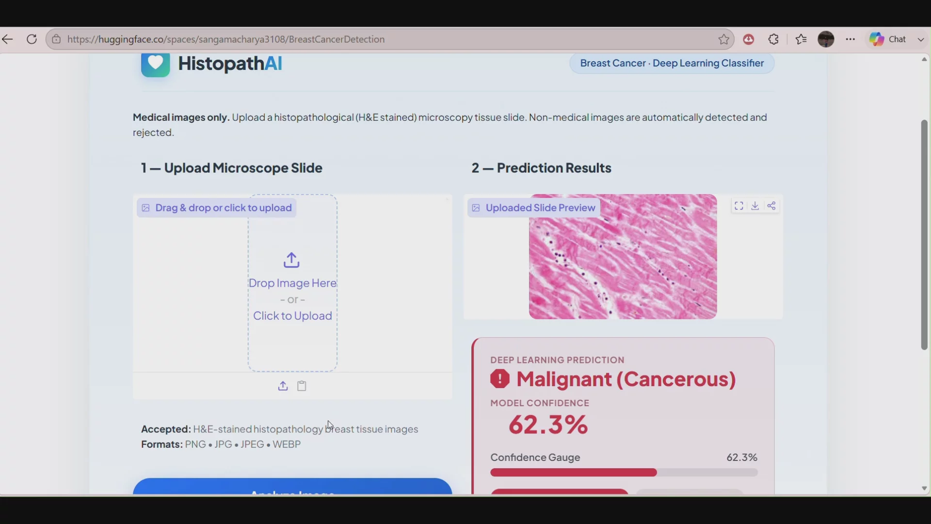 Breast cancer detection image 1