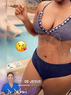 Tummy Tuck result at Spectrum Aesthetics