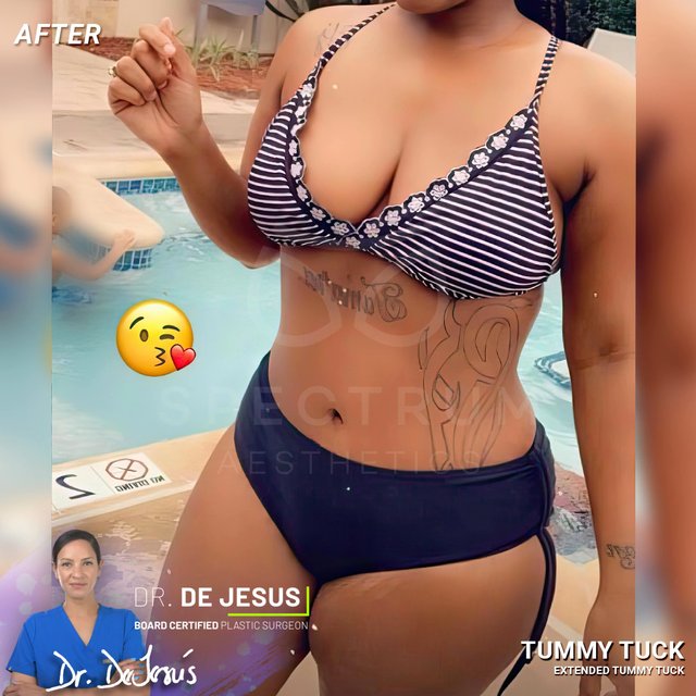 Tummy Tuck result at Spectrum Aesthetics