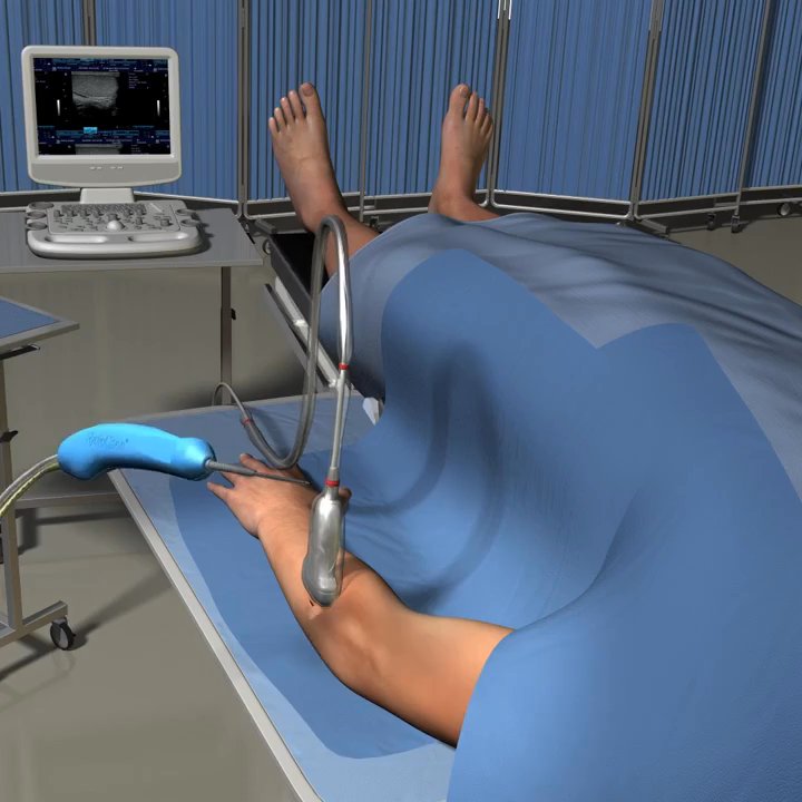 Genesis Orthopaedic and Spine - Dr. Chopra performs Tenjet procedure to get rid of chronic tendon scar tissue such as golfers elbow, hip bursitis, rotator cuff tendinitis - Sports Medicine Near Me - Westfield, New Jersey