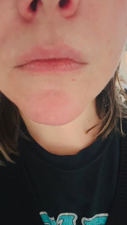 Blue Sage Dental - This is the jaw situation after my visit here. - Cosmetic Dentists Near Me - Littleton, Colorado