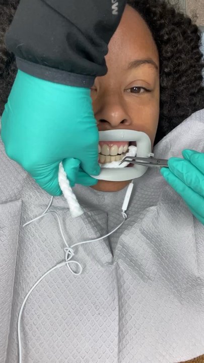 The Smile Spa - Getting ready for laser! Amazing service! - General Dentistry Near Me - Irving, Texas