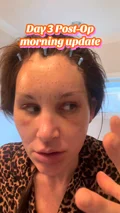 @loranrichards, day 3 after an endoscopic brow lift