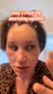 @loranrichards, day 3 after an endoscopic brow lift