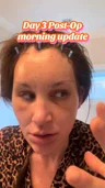 @loranrichards, day 3 after an endoscopic brow lift