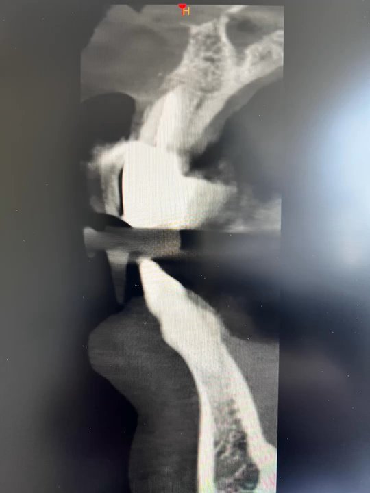 Vick Kargodorian, DDS - Immediate implant after extraction - General Dentistry Near Me - Hollywood, California