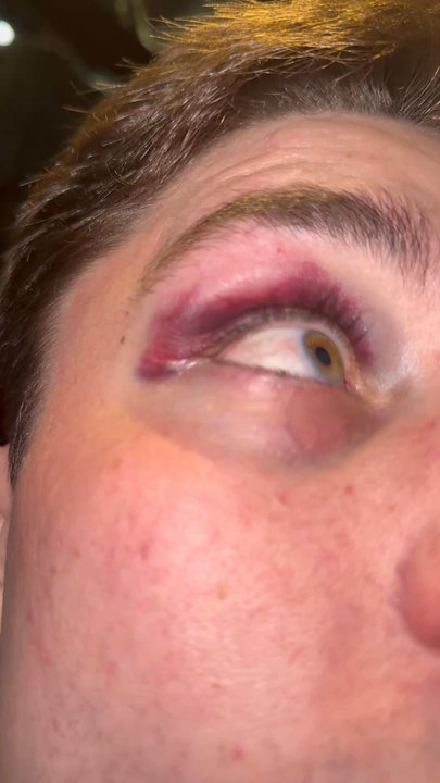 Cowgirls - Clear injury proof. This is from the metal door hitting my face. - Sports Bars Near Me - Seattle, Washington