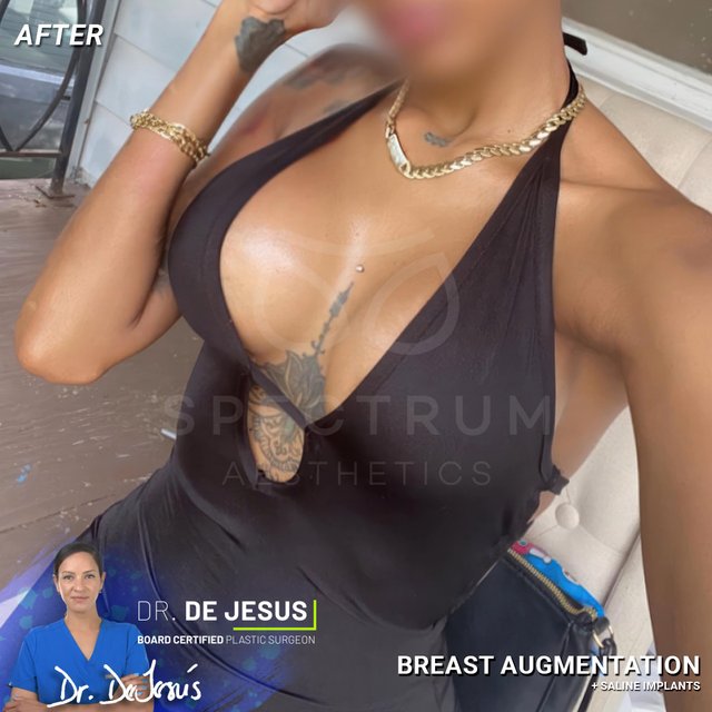 Breast Augmentation result at Spectrum Aesthetics