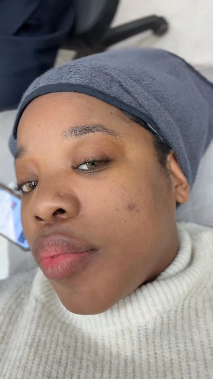 Picotoning · LED Treatment Review (Benjamin Clinic)