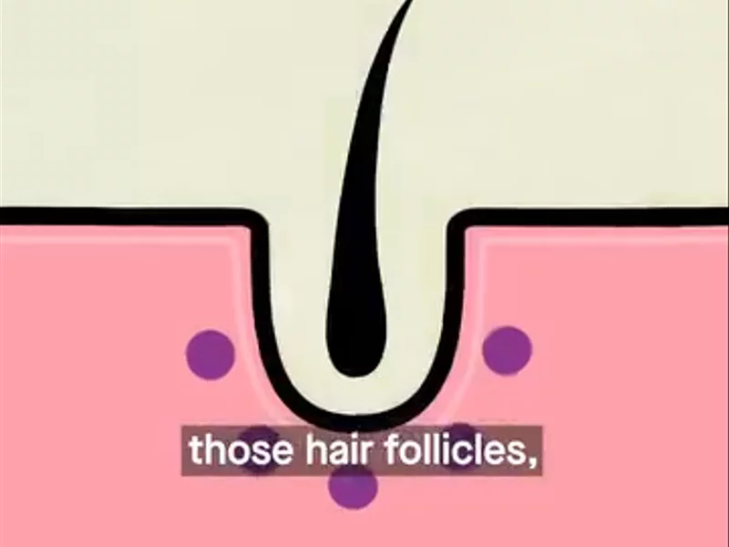 Mosh Hair Loss