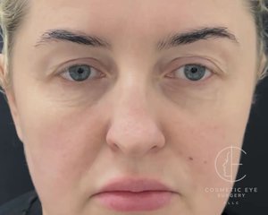 Upper Eyelid Blepharoplasty Patient Image #1