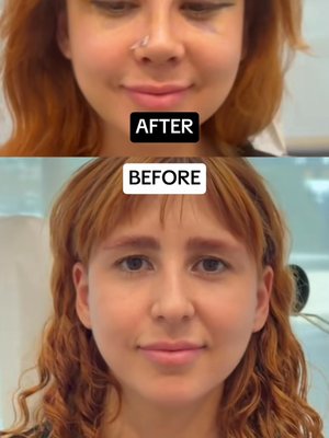 Rhinoplasty result at Eos Rejuvenation
