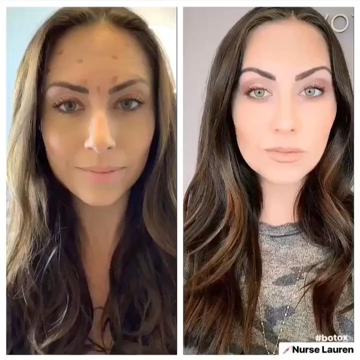 Modern Med STL Medspa - Botox before and after - Medical Spas Near Me - St. Louis, Missouri