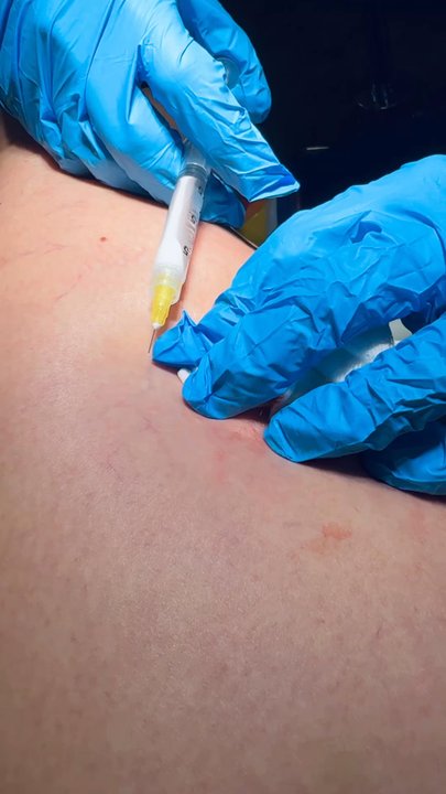 Frontier Dermatology  - Sclerotherapy with Dr. Lawlor & staff - Dermatologists Near Me - Edmonds, Washington