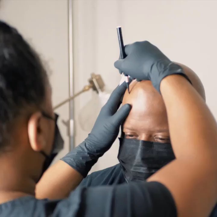 Scalp Prodigy - Scalp Micropigmentation Training for Artist from Atlanta. His hairline turned out beautifully. - Hair Loss Centers Near Me - Las Vegas, Nevada