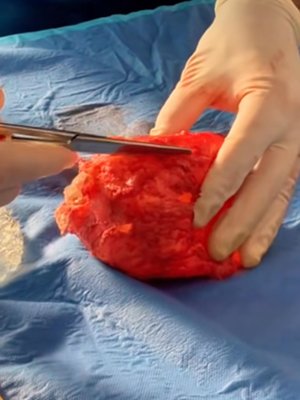 Breast Augmentation result at Dr. York Yates Plastic Surgery