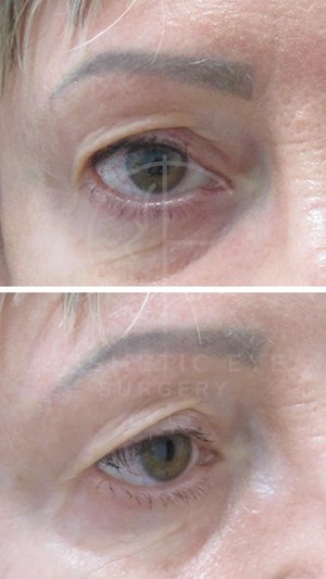 Upper Eyelid Blepharoplasty Patient Image #1