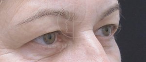 Upper Blepharoplasty  Patient Image #1