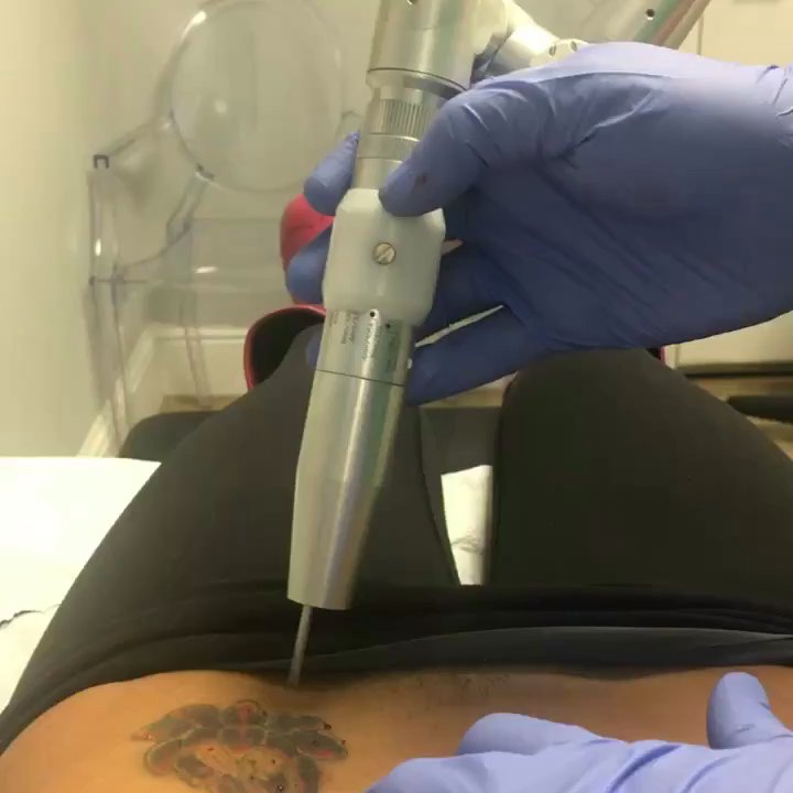 Tribeca Medaesthetics - First laser tattoo removal session - Medical Spas Near Me - Miami Beach, Florida