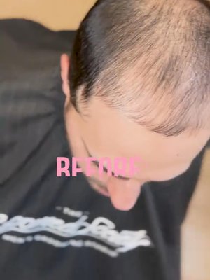 Prp Hair result at Unicorn Medical Weight Loss and Medi Spa
