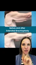 @greerplastics · What an arm lift treats