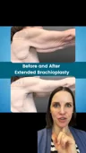 @greerplastics · What an arm lift treats