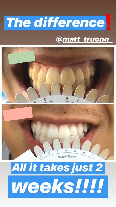 Brian Lee, DDS - My brother's teeth went from butterscotch to winter fresh within 2 weeks!!!!!! Customized bleaching trays is a must! - General Dentistry Near Me - Fountain Valley, California