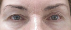 Upper Blepharoplasty for Eyelid Asymmetry.  Patient Image #1