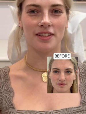 Rhinoplasty result at Eos Rejuvenation
