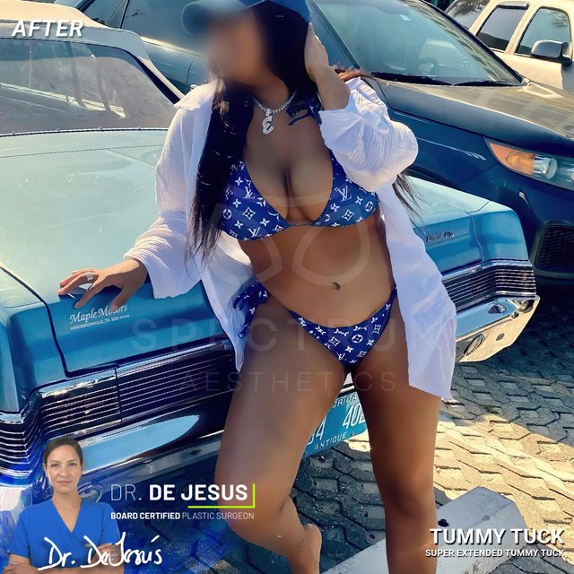 Tummy Tuck result at Spectrum Aesthetics