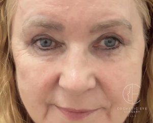 Upper Eyelid Blepharoplasty  Patient Image #1