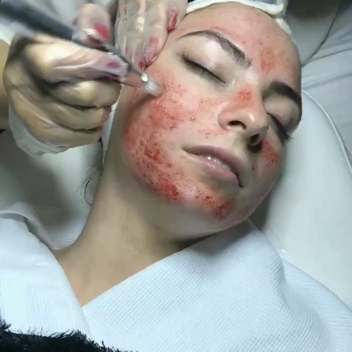 Dejolie - Microneedling - Skin Care Near Me - Clifton, New Jersey