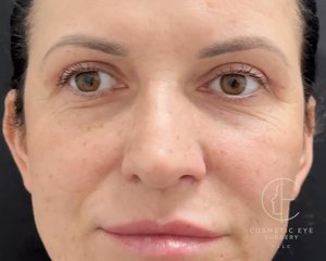 Upper Eyelid Blepharoplasty Patient Image #1