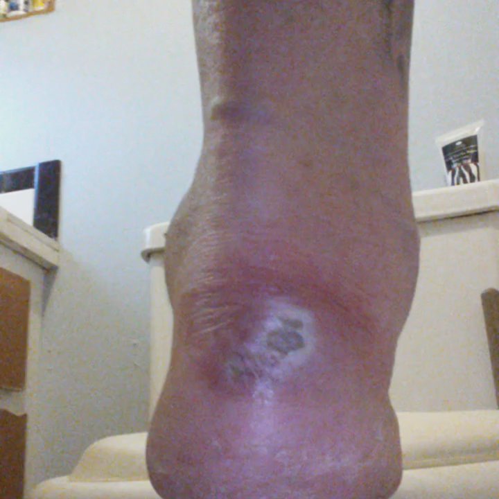 Uptown Nail - This is after what happened getting a pedicure at Uptown nail salon. Alex was the nail technician  July 6 2015. - Nail Salons Near Me - Mount Dora, Florida