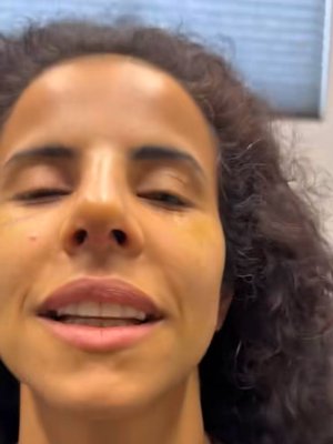 Rhinoplasty result at Dr. Rady Rahban