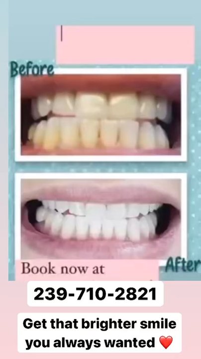 Ageless Beauty - Before after teeth whitening. - Day Spas Near Me - Naples, Florida