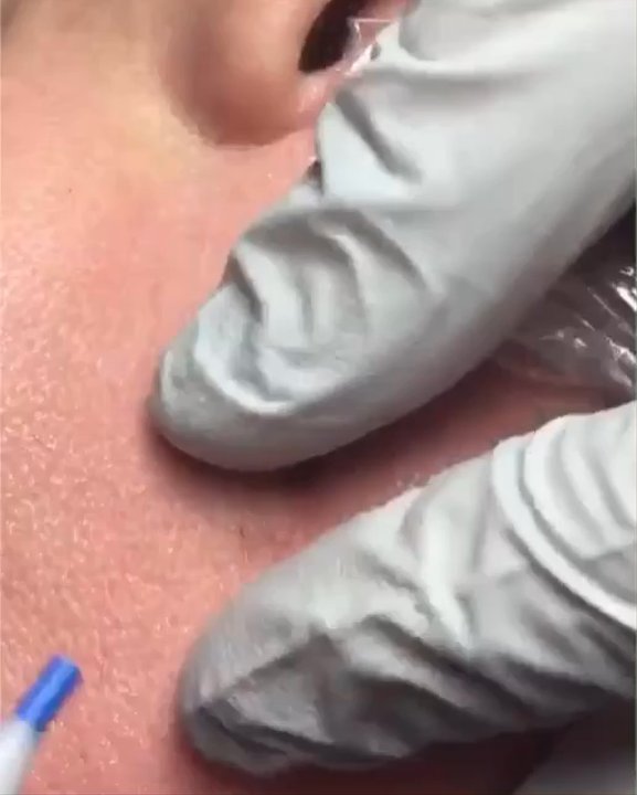 Electrolysis Center - Final hairs on full facial clearing for GRS. - Laser Hair Removal Near Me - Universal City, Texas