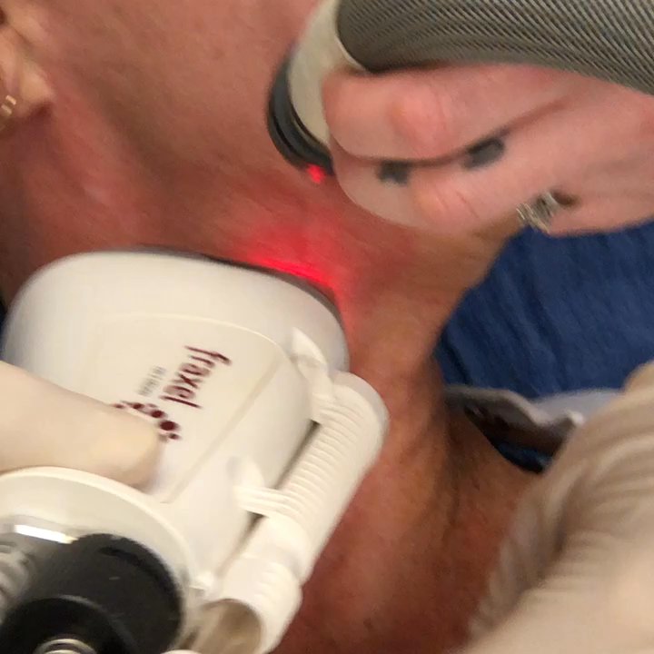SkinRenuit Medspa - Fraxel restore for the neck. - Medical Spas Near Me - Poway, California
